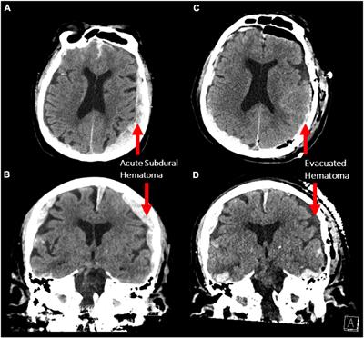 Enhanced Interplay of Neuronal Coherence and Coupling in the Dying Human Brain